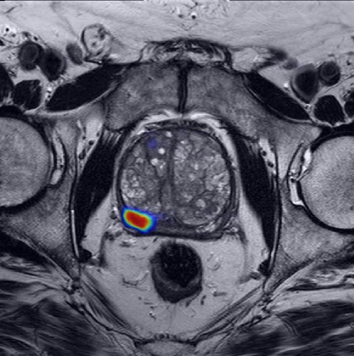 Can Artificial Intelligence Help See Cancer in New Ways?